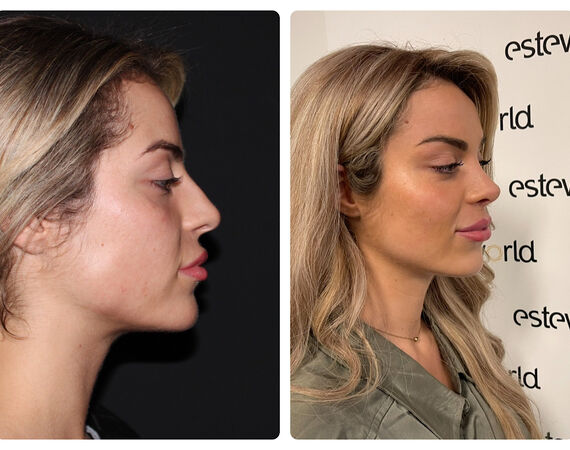 Neuscorrectie Turkije