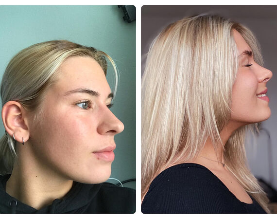 Neuscorrectie Turkije