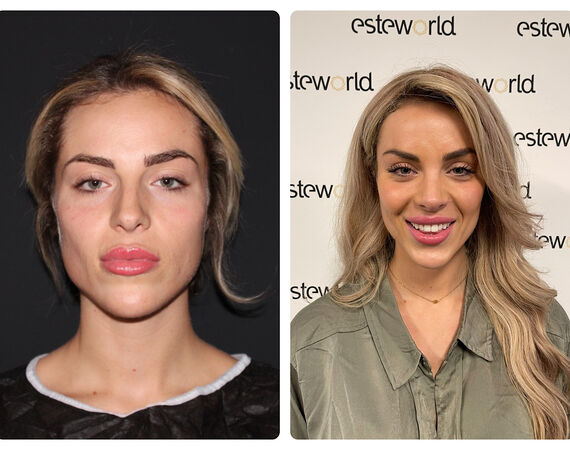 Neuscorrectie Turkije