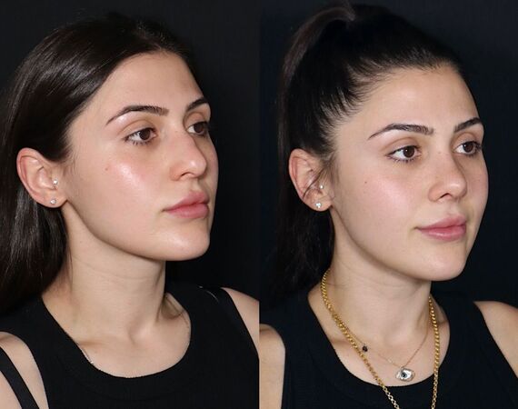 Neuscorrectie Turkije