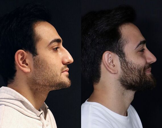 Neuscorrectie Turkije