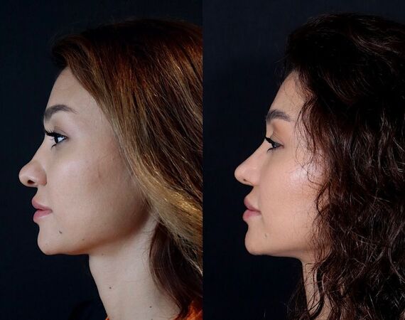 Neuscorrectie Turkije