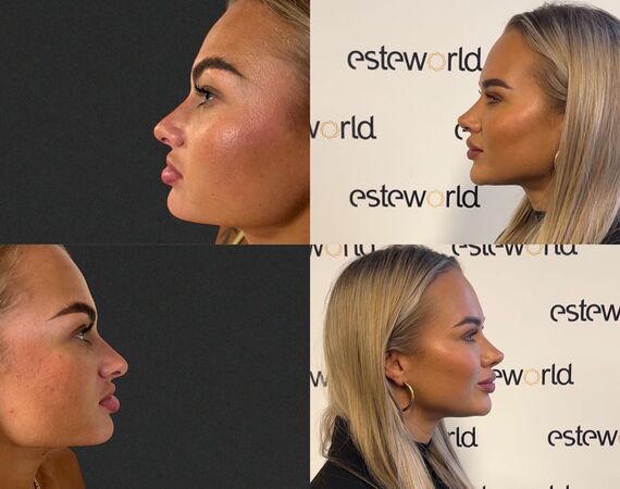 Neuscorrectie Turkije