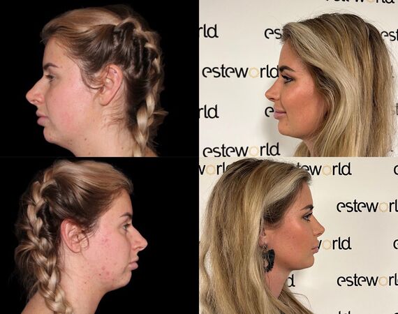 Neuscorrectie Turkije