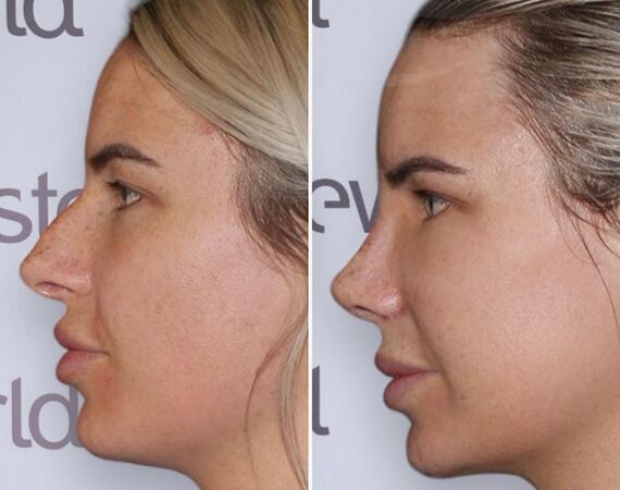 Neuscorrectie Turkije