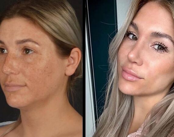 Neuscorrectie Turkije