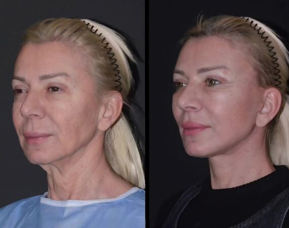 Facelift Turkije