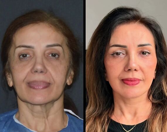 Facelift Turkije
