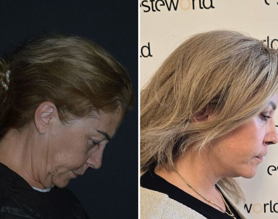 Facelift Turkije