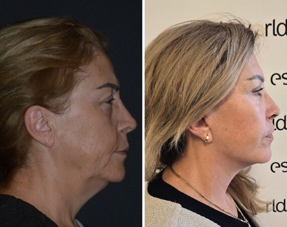 Facelift Turkije