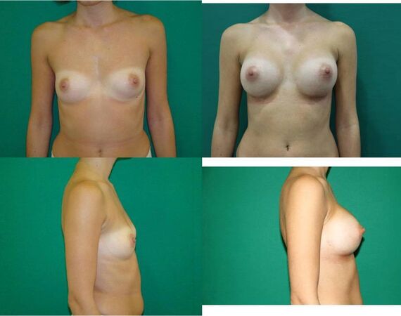 Borstvergroting Turkije