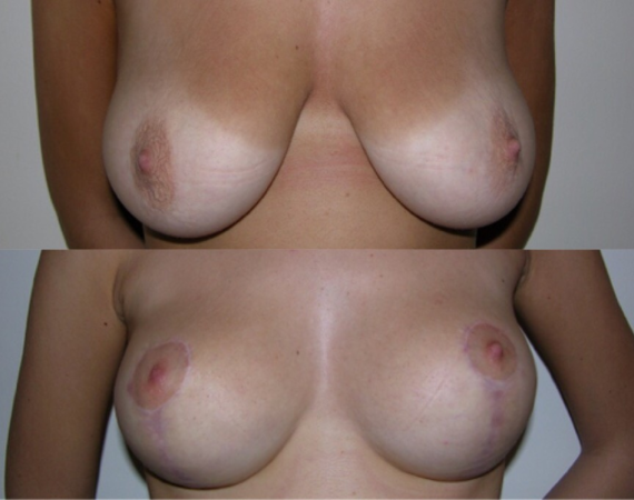 Borstvergroting Turkije