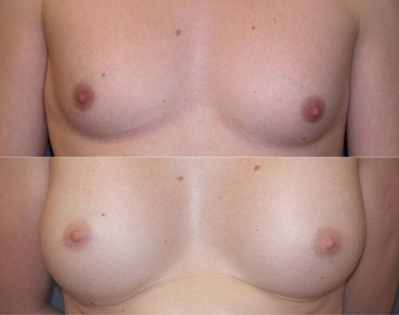 Borstvergroting Turkije