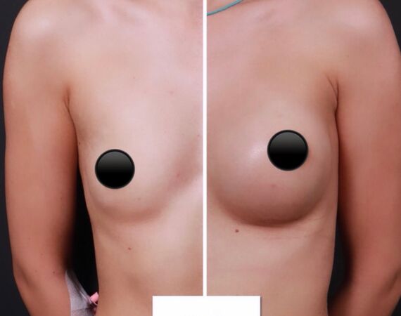 Borstvergroting Turkije