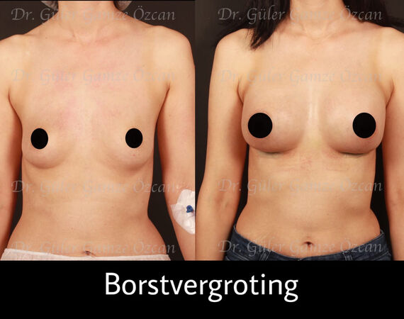 Borstvergroting Turkije