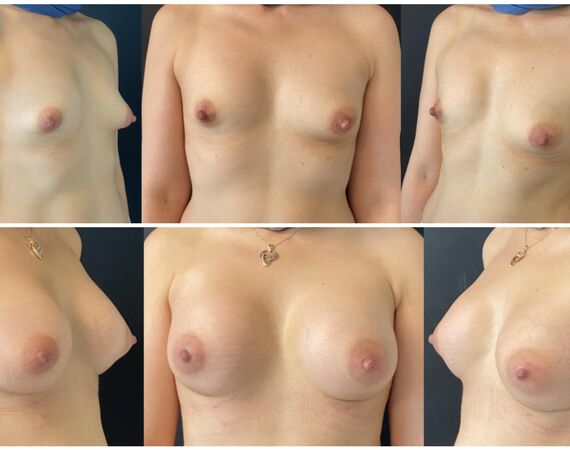 Borstvergroting Turkije