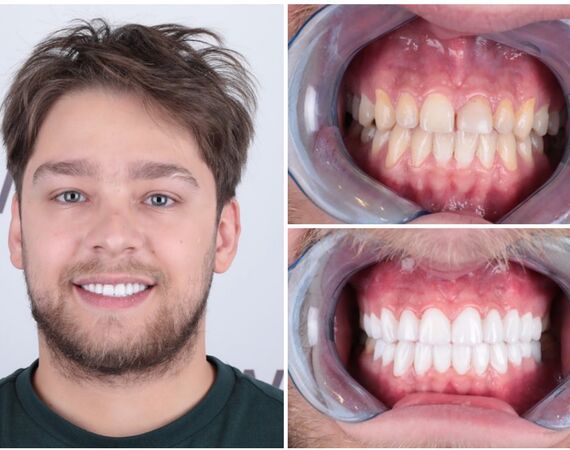 Tandimplantaten Turkije