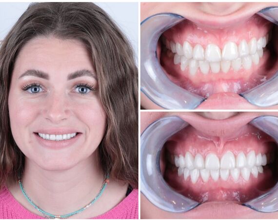 Tandimplantaten Turkije