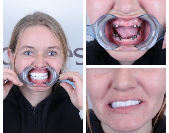 Tandimplantaten Turkije