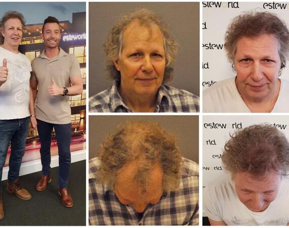 Haartransplantatie Turkije