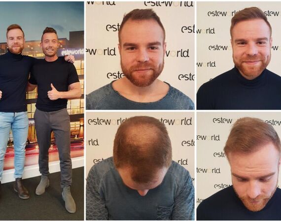 Haartransplantatie Turkije