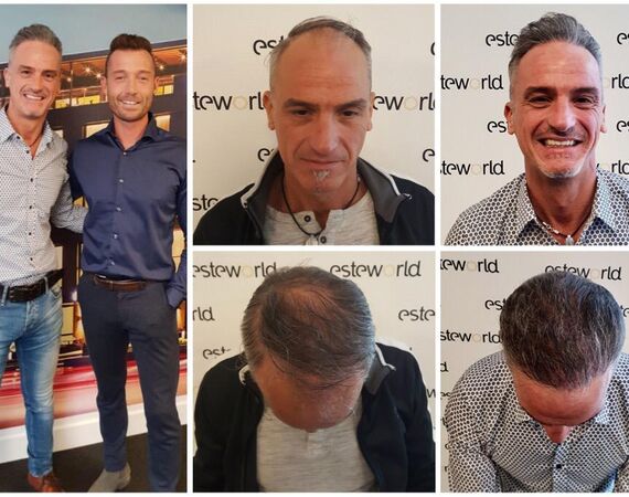 Haartransplantatie Turkije