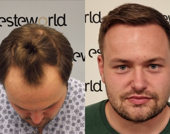 Haartransplantatie Turkije