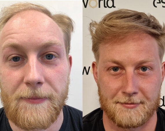 Haartransplantatie Turkije