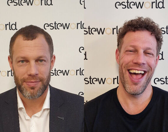 Haartransplantatie Turkije