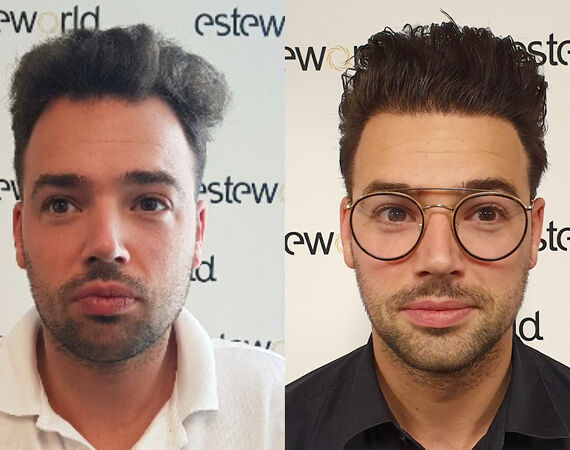 Haartransplantatie Turkije