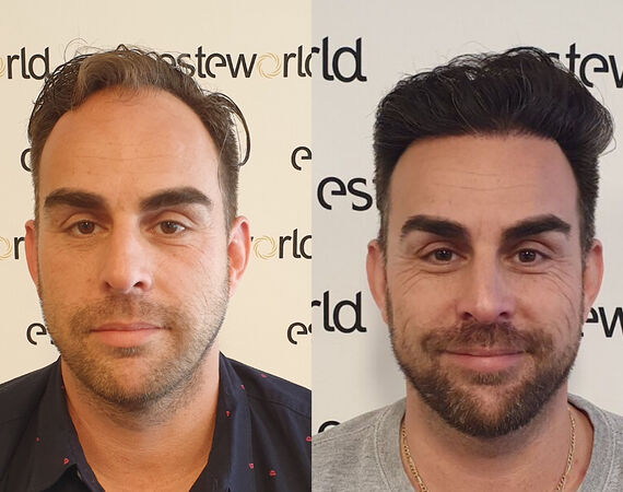 Haartransplantatie Turkije