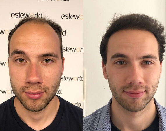 Haartransplantatie Turkije