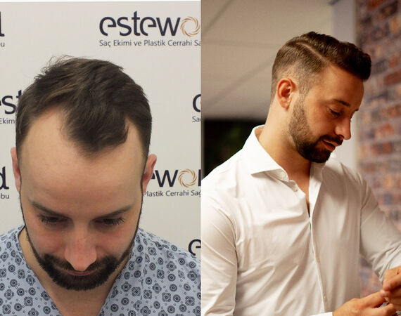 Haartransplantatie Turkije