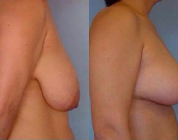 Borst verkleining Turkije