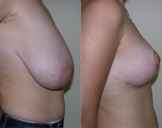 Borst verkleining Turkije