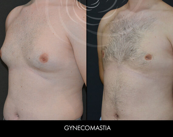 Mannelijke borstverkleining