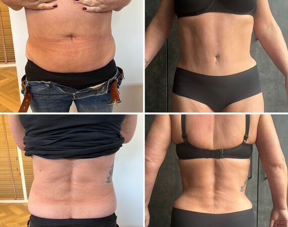 Buikwandcorrectie Turkije