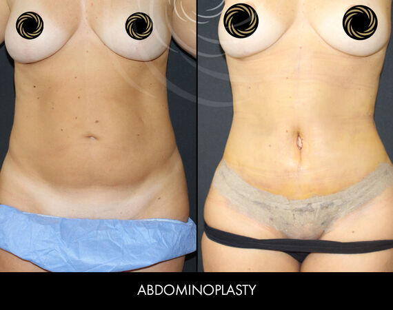 Buikwandcorrectie Turkije