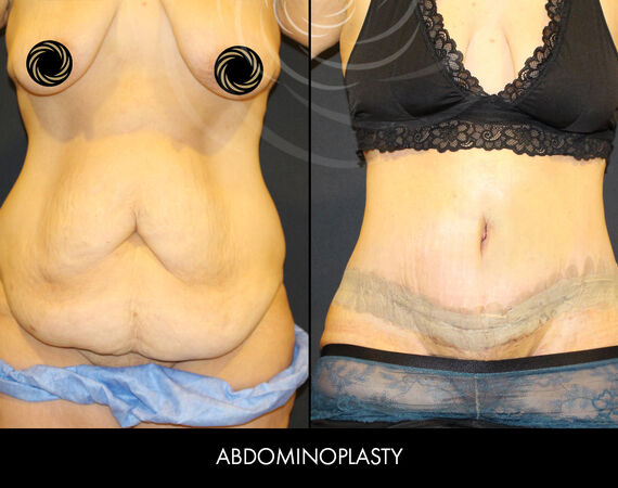 Buikwandcorrectie Turkije