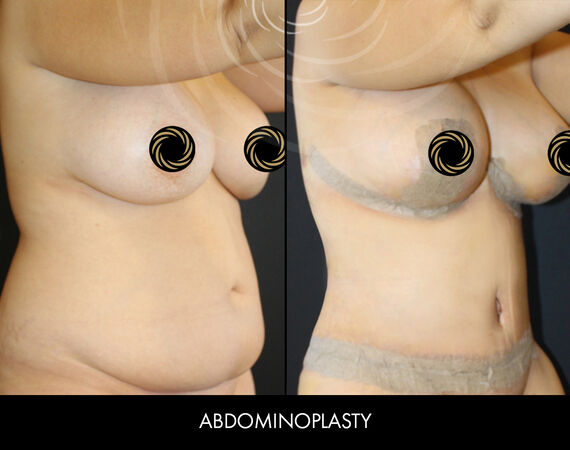 Buikwandcorrectie Turkije