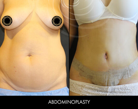 Buikwandcorrectie Turkije