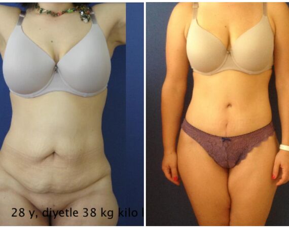 Liposuctie Turkije