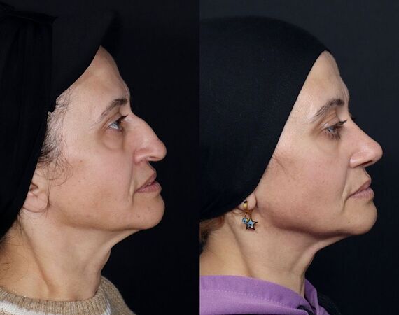 Neuscorrectie Istanbul