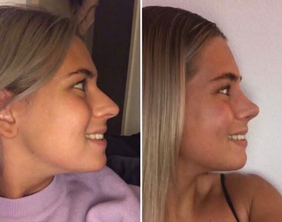 Neuscorrectie Istanbul