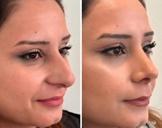 Neuscorrectie Istanbul