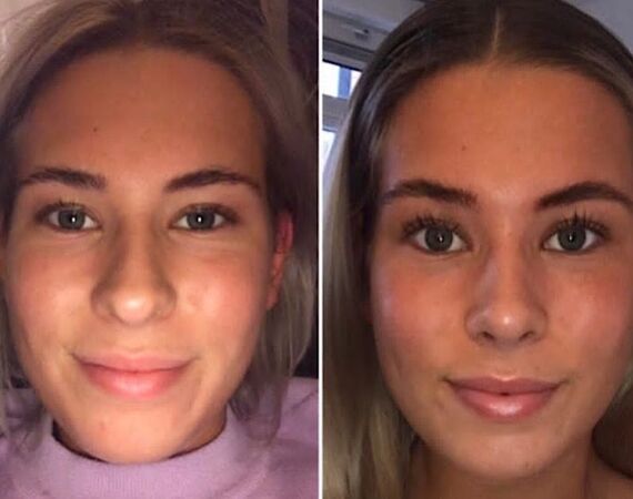 Neuscorrectie Istanbul