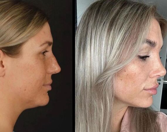 Neuscorrectie Istanbul