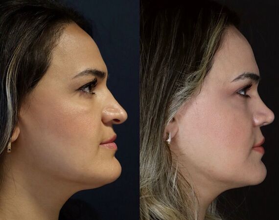 Neuscorrectie Istanbul