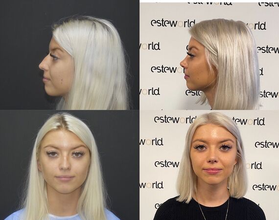 Neuscorrectie Istanbul