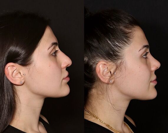 Neuscorrectie Istanbul